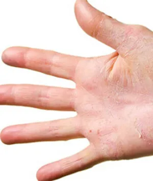 Psoriasis